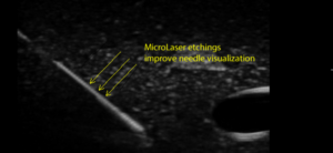 Needle MicroLaser